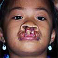 Analyn vorher, Operation Restore Hope