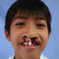 Randy vorher, Operation Restore Hope