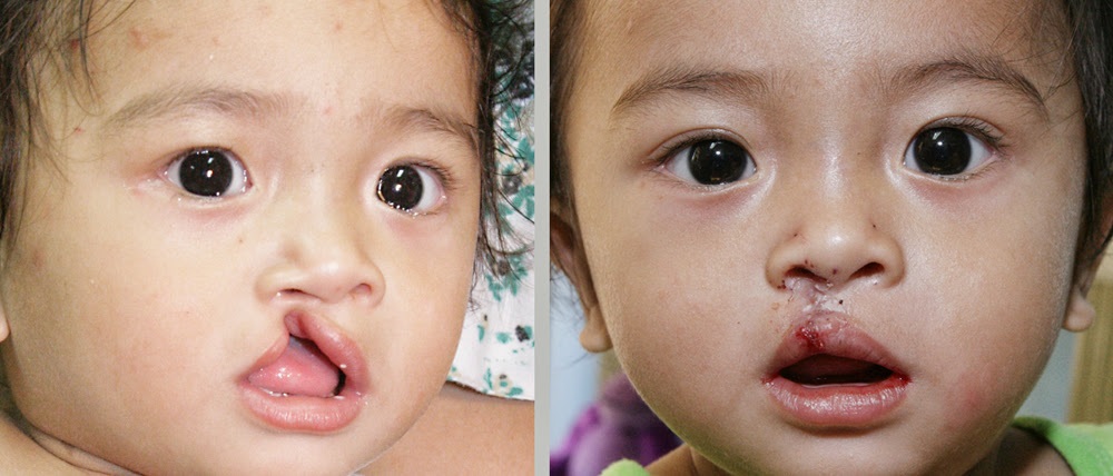 vor und nach der operation der lippenspalte